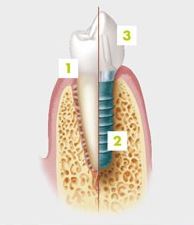 implante dental sevilla